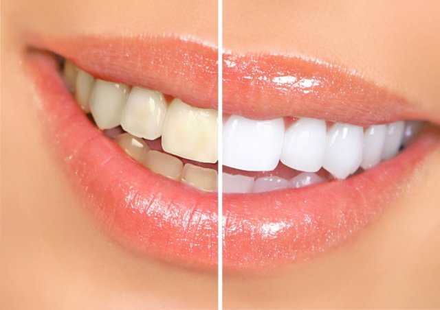 Особенности офисного отбеливания зубов